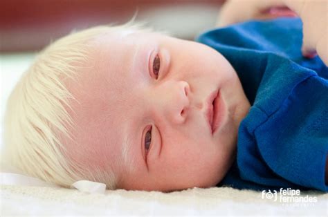Albinism Achromasia — Definition And Genetics Lecturio