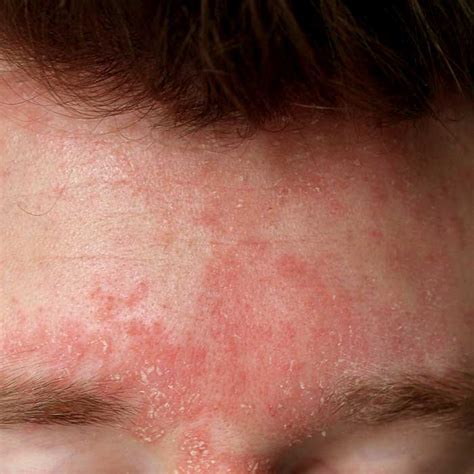 Dermatite Seborroica Viso Sintomi Cause E Trattamento