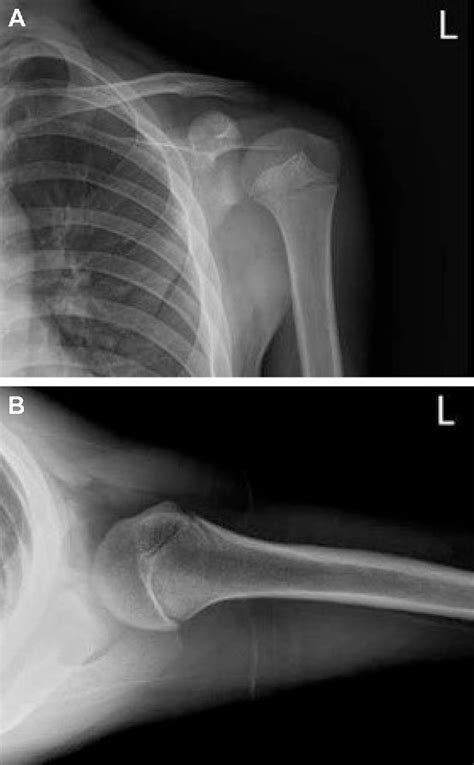 Figure From Isolated Avulsion Fracture Of The Lesser Tuberosity Of The Humerus In An