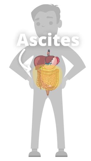 Ascites Fluid In The Abdomen Cirrhosis Care