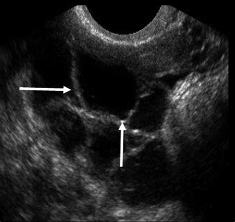 Sonography Of The Abnormal Fallopian Tube Ajr