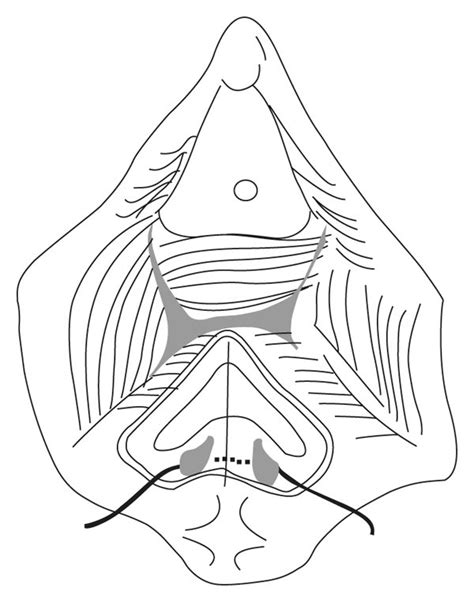 A A Curvilinear Incision Was Made Anterior To The Rectum And A Plane