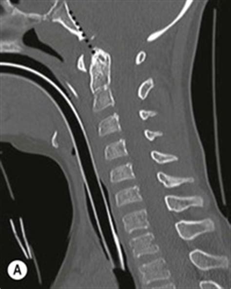Spinal Trauma Radiology Key