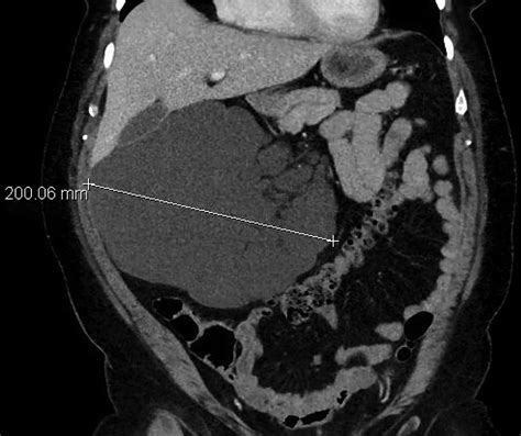 Large Mesenteric Lymphangioma In An Adult Patient An Unusual