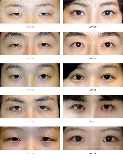 Heres What Idols Go Through When They Get Double Eyelid Surgery