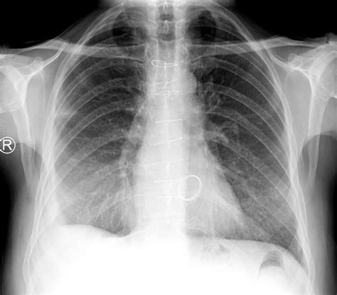 Melody Pulmonary Valve Buyxraysonline