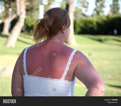 Sunburn Woman Stock Photo Stock Images Bigstock