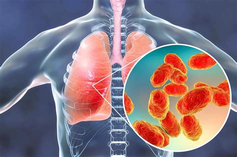 New Rapid Test Diagnoses Pneumonia And Other Lower Respiratory Infections