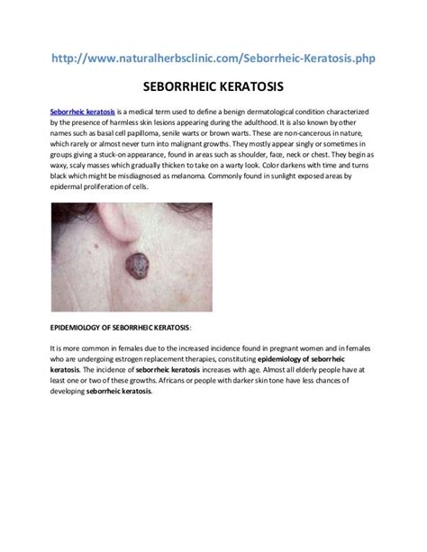 Seborrheic Keratosis Treatment Symptoms Causes Of Seborrheic Kerato