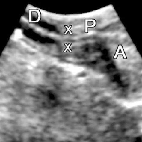 Transverse B Mode Ultrasonographic View Of The Normal Pyloric Sphincter