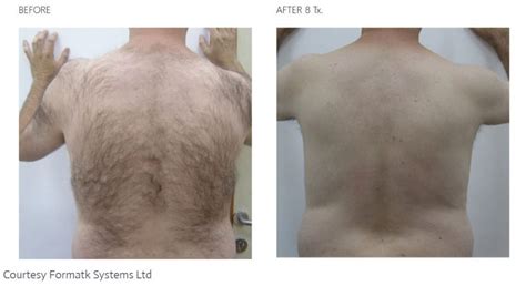 Vitamin Tarif Mentor Male Laser Hair Removal Before And After Erlaubnis