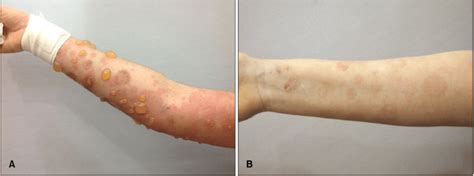 A Large Tense Bullae And Erythematous Pruritic Plaques On The Arm