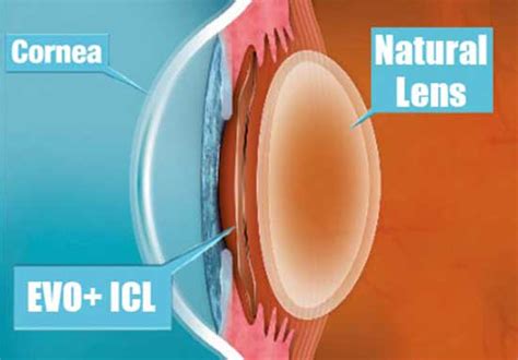 Icl Surgery Implantable Contact Lens Surgery Centre For Sight Uk
