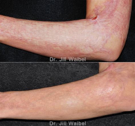 Burn Scar Treatment Before And After Pictures In Miami Fl