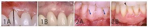 Caries Management In Pediatric Dentistry Decisions In Dentistry