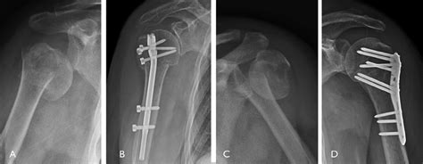 Proximal Humeral Fracture Treated With Locking Intramedullary Nail Is