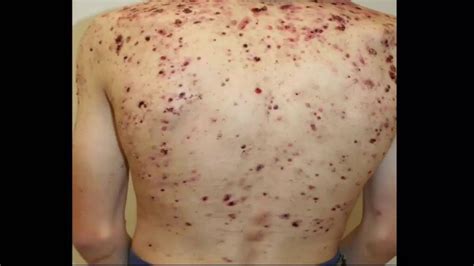 Cystic Acne Popping On Back
