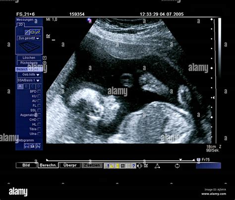 Ultrasonic Supersonic Ultrasonic Diagnosis Baby Symbol Of Health