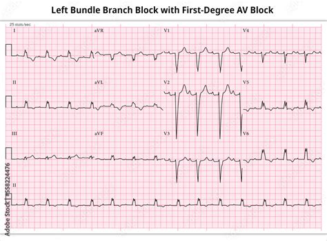 Ecg First Degree Av Block With Lbbb Left Bundle Branch Block 12