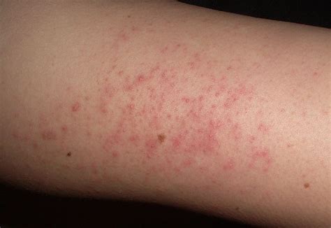 Pimples On Arms Causes Treatment Home Care Pictures Diseases