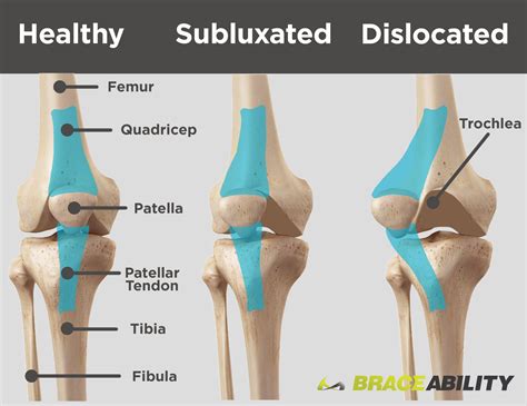 Use This Diagram To See The Difference Between A Subluxated Kneecap And