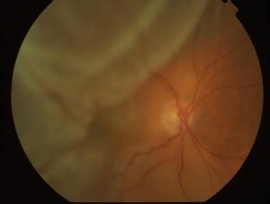 Retina Detachment Ophthalmology Treatment Frederick MD Greater