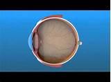 Detached Retina Recovery Time Images
