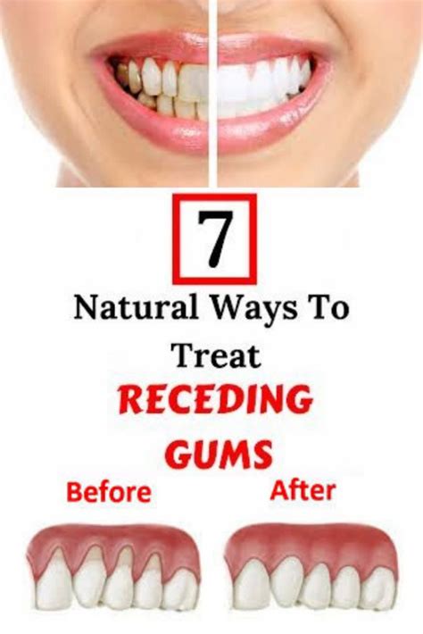 7 Natural Ways To Treat Receding Gums Receding Gums Gum Inflammation