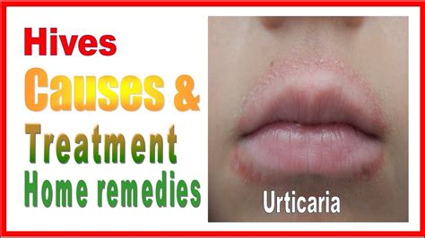 Hives On Lips Home Treatment Axis Medical