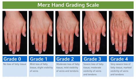 「手」は年齢を語る：手の若返り治療について ①総論＆シミ問題 Beauty Tuning Clinic