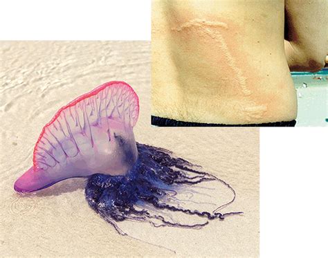 Jellyfish Sting Symptoms How To Treat A Jellyfish Sting