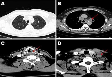 Full Text Immunotherapy In Lung Cancer A Case Report And Review Of