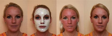 Face Brown Spots Treatment Doctor Heck