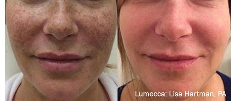 Lumecca Ipl Axis Clinic Advanced Aesthetic Skin Treatments