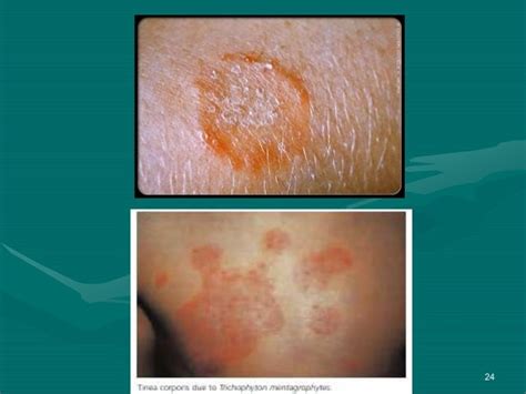 Dermatophytes Infections