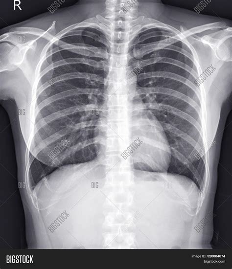 Chest X Ray Female 36 Image And Photo Free Trial Bigstock