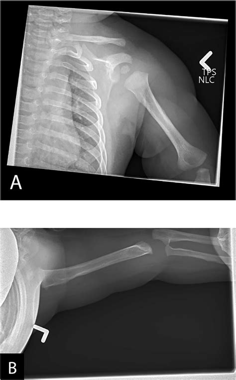 Anteroposterior And Axillary Shoulder X Rays At 5 Months Of Age