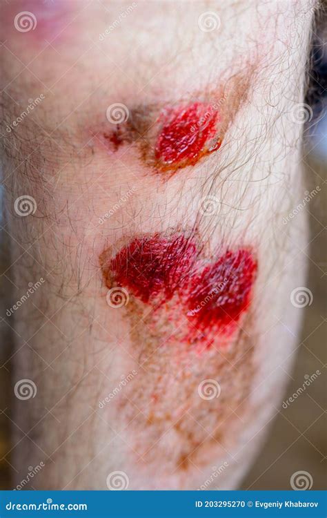 A Man`s Red Bloody Painful Leg Injury From A Fall While Sport Sports