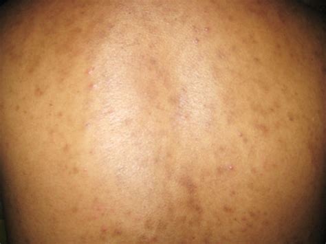 The Holistic Body Care Blog Discovering A Skin Solver Burn And Acne