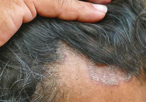 What Causes Seborrheic Dermatitis Face