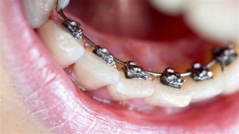 What You Need To Know About Lingual Braces