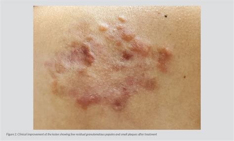 Figure 2 From A Rare Case Of Benign Histiocytic Neoplasm Of Cutaneous