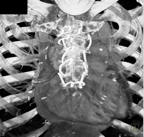 Sternal Wires Following Medial Sternotomy Chest Case Studies Ctisus
