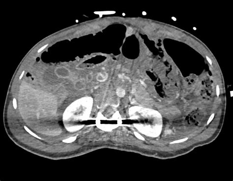 Infarcted Bowel With Portal Venous Gas And Pneumoperitoneum Small