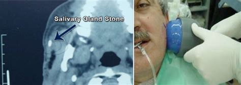 Salivary Gland Stones Treatment Lithotripsy