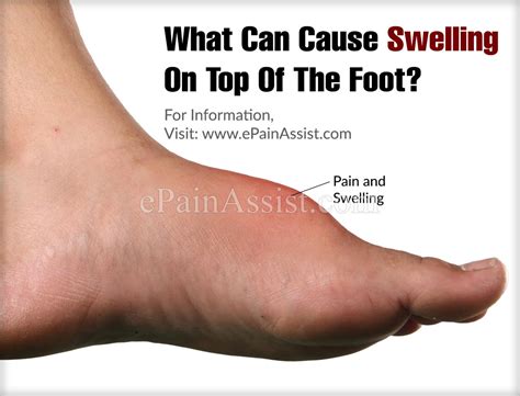 What Can Cause Swelling On Top Of The Foot Picture