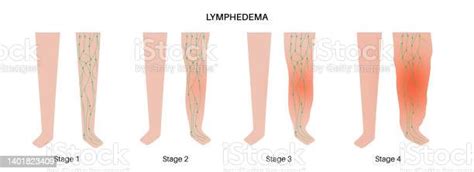 Stages Of Lymphedema Stock Illustration Download Image Now