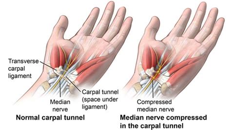 Carpal Tunnel Syndrome Treatment Orchard Health Clinic