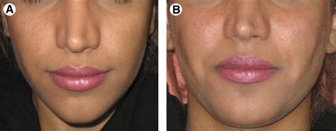 Use Of Platelet Rich Fibrin And Platelet Rich Plasma In Combination