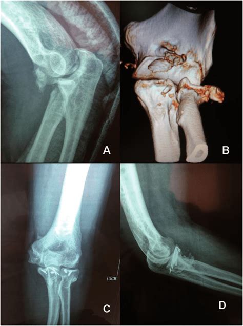 Photographs Of A 63 Year Old Man Who Sustained A Terrible Triad Injury